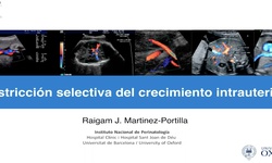 Restricción selectiva del crecimiento en el embarazo gemelar